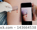 Hand holds a smartphone next to two moles on a back while the screen shows an earlier closeup of the same moles with a ruler. Mole mapping and tracking of skin changes for early melanoma detection. 143664538