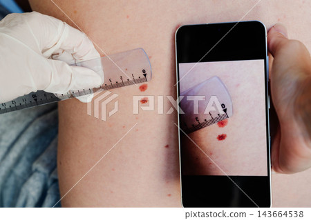 Hand holds a smartphone next to two moles on a back while the screen shows an earlier closeup of the same moles with a ruler. Mole mapping and tracking of skin changes for early melanoma detection. Hand holds a smartphone next to two moles on a back while the screen shows an earlier closeup of the same moles with a ruler. Mole mapping and tracking of skin changes for early melanoma detection. 143664538