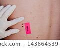 Gloved hand of a dermatologist stretches skin on a back dotted with moles beside a marker sticker and two nevi of uneven outline. Dermoscopy screening for early melanoma detection and prevention. 143664539