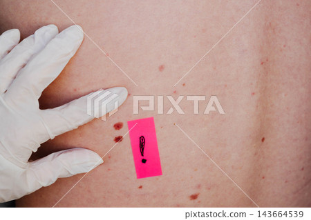 Gloved hand of a dermatologist stretches skin on a back dotted with moles beside a marker sticker and two nevi of uneven outline. Dermoscopy screening for early melanoma detection and prevention. Gloved hand of a dermatologist stretches skin on a back dotted with moles beside a marker sticker and two nevi of uneven outline. Dermoscopy screening for early melanoma detection and prevention. 143664539