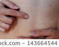 Finger points at a pale round scar left on back skin after removal of a large mole, with smaller moles and red spots nearby. Dermatology close-up for melanoma prevention and postoperative scar care. 143664544