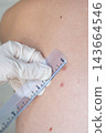 Gloved dermatologist measures a large pigmented mole with a ruler on the bare back of a patient. Melanoma prevention and skin cancer screening in dermatology practice. 143664546