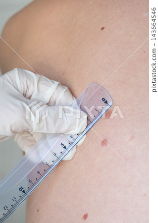 Gloved dermatologist measures a large pigmented mole with a ruler on the bare back of a patient. Melanoma prevention and skin cancer screening in dermatology practice. Gloved dermatologist measures a large pigmented mole with a ruler on the bare back of a patient. Melanoma prevention and skin cancer screening in dermatology practice. 143664546