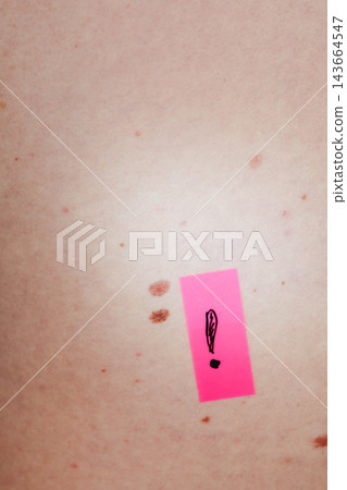 Close-up of skin with scattered moles and freckles beside a pink sticker marked with a hand drawn exclamation point. Mole mapping and skin self-examination support early melanoma detection. Close-up of skin with scattered moles and freckles beside a pink sticker marked with a hand drawn exclamation point. Mole mapping and skin self-examination support early melanoma detection. 143664547