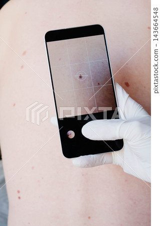 A gloved hand holds a smartphone over a bare back, with the screen magnifying one mole among many on the skin. Mole mapping and regular self-monitoring support early skin cancer detection. A gloved hand holds a smartphone over a bare back, with the screen magnifying one mole among many on the skin. Mole mapping and regular self-monitoring support early skin cancer detection. 143664548