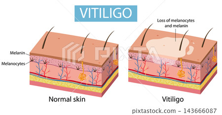 Medical Diagram Comparing Normal Skin Layers and Vitiligo Condition Medical Diagram Comparing Normal Skin Layers and Vitiligo Condition 143666087