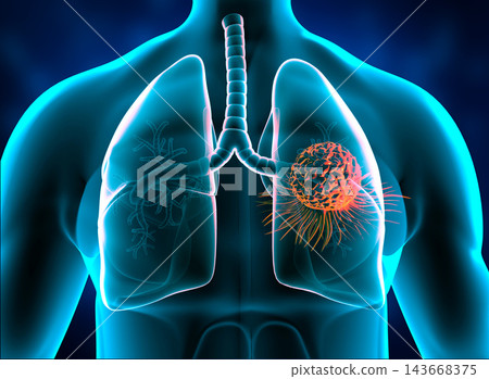 Lungs cancer, tumor in lungs Lungs cancer, tumor in lungs 143668375