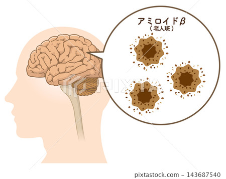 阿茲海默症患者的大腦：β-澱粉樣蛋白和tau蛋白 143687540