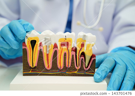 Dentist holding dental implant, artificial tooth roots into jaw, root canal of dental treatment, gum disease, teeth model for dentist. Dentist holding dental implant, artificial tooth roots into jaw, root canal of dental treatment, gum disease, teeth model for dentist. 143701476