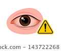 human eye showing redness and blood vessels with a warning symbol 143722268