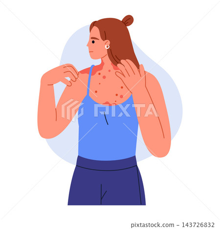 Woman examining red skin rashes on her neck, chest, and shoulders. Allergic reaction. Allergy, skin condition and dermatology concept. Vector illustration in cartoon style. Isolated on white backgroun 143726832