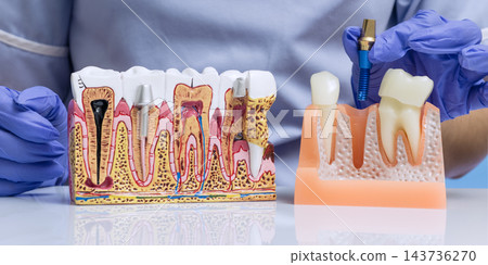 Dentist Demonstrating Dental Implant Placement Using Titanium Screw and Anatomical Teeth Models in Modern Dentistry Clinic 143736270