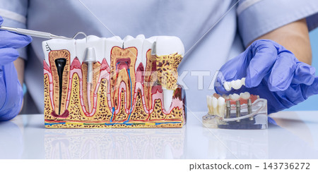 Dentist Demonstrating Dental Implant Supported Bridge and Tooth Replacement Using Detailed Jawbone Anatomy Model in Clinic Dentist Demonstrating Dental Implant Supported Bridge and Tooth Replacement Using Detailed Jawbone Anatomy Model in Clinic 143736272