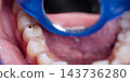 Dental caries on a lower molar shown in a detailed intraoral close-up with teeth, gums and a blue dental instrument 143736280