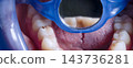 Dental mirror reflecting teeth during an intraoral examination with visible cavities on lower molars 143736281