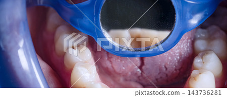 Dental mirror reflecting teeth during an intraoral examination with visible cavities on lower molars 143736281
