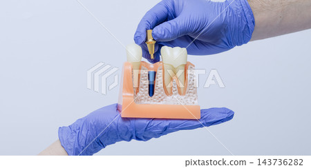 Dental implant model with removable abutment held in blue gloved hands against a light background Dental implant model with removable abutment held in blue gloved hands against a light background 143736282