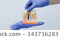 Gloved hands demonstrating crown placement on a dental implant using a cross-section model of teeth and jawbone 143736283