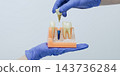 Artificial tooth crown with abutment lifted above a dental implant model to explain tooth replacement 143736284