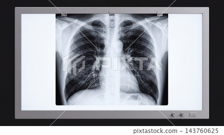 Chest X-ray Film Displayed on Medical Light Box for Pulmonary Diagnosis Chest X-ray Film Displayed on Medical Light Box for Pulmonary Diagnosis 143760625