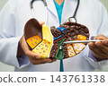 Cirrhosis, Liver cancer, fatty liver, Asian doctor with liver human model. 143761338