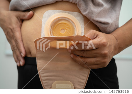 Asian woman colostomy bag container outside for body waste. 143763916