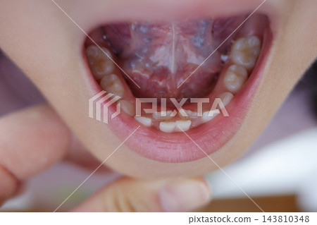 兒童口腔內,恆牙正在乳牙後方萌出(替換下前牙)。 兒童口腔內,恆牙正在乳牙後方萌出(替換下前牙)。 143810348