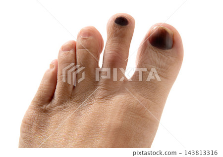 因受傷導致腳趾甲內出血。 因受傷導致腳趾甲內出血。 143813316