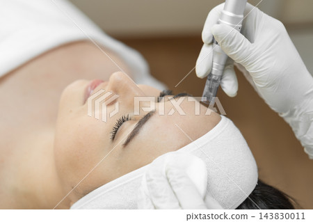 Closeup of a relaxing microneedling procedure performed by a gloved specialist on a woman's forehead. The treatment aims to improve skin texture, boost collagen, and enhance facial radiance Closeup of a relaxing microneedling procedure performed by a gloved specialist on a woman's forehead. The treatment aims to improve skin texture, boost collagen, and enhance facial radiance 143830011