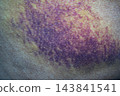 Bruise on the buttock skin injury from accident at home. 143841541
