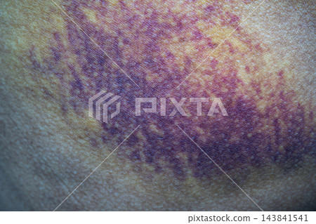 Bruise on the buttock skin injury from accident at home. Bruise on the buttock skin injury from accident at home. 143841541