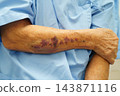 Ecchymosis, elderly bleeding on her arm after taking aspirin. 143871116