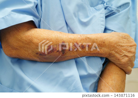 Ecchymosis, elderly bleeding on her arm after taking aspirin. Ecchymosis, elderly bleeding on her arm after taking aspirin. 143871116