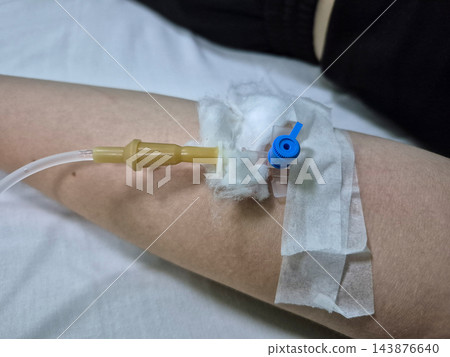 Peripheral Venous Catheter Secured on Patient Arm with Transparent Medical Dressing Peripheral Venous Catheter Secured on Patient Arm with Transparent Medical Dressing 143876640