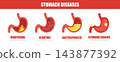 Stomach diseases. Burn, cancer, bloating and gastroparesis. Medical check up. Vector illustration in flat cartoon style 143877392