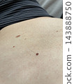 Hair growing from a mole 143888750